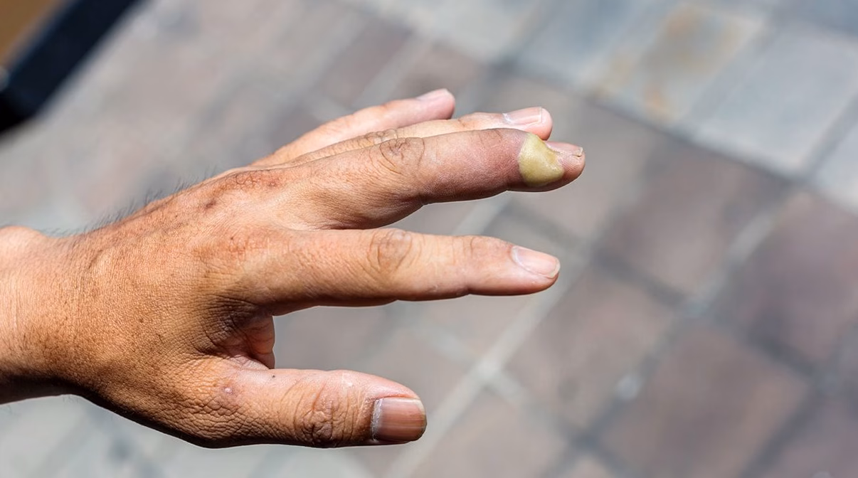 Ongles cassants: causes et solutions